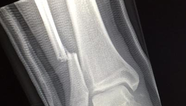 Broken Leg Forces Foo Fighters to Cancel Shows